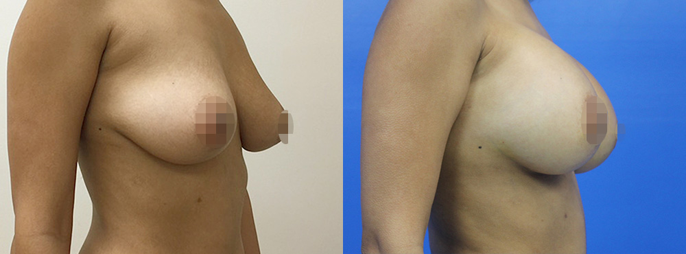 Breast Augmentation Before and After