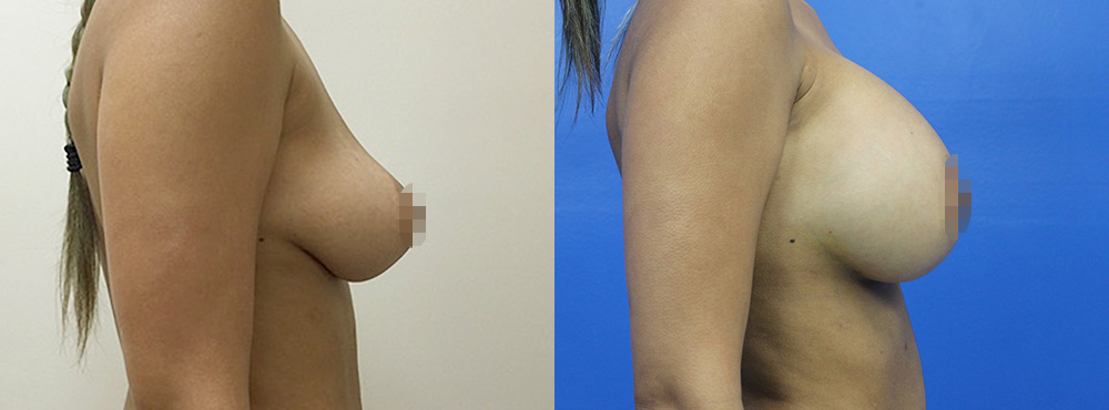 Breast Augmentation Before and After