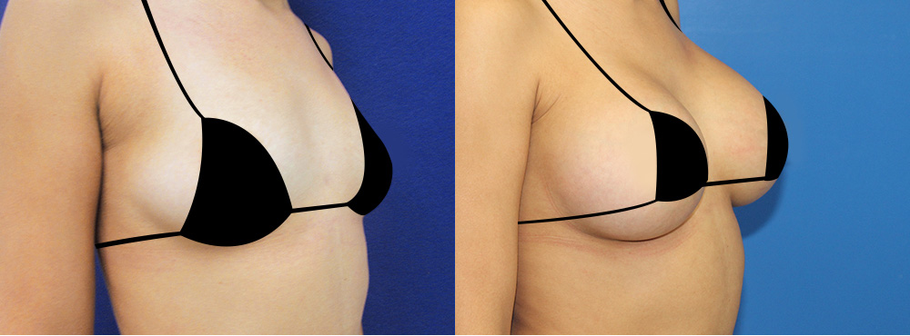 Breast Augmentation Before and After in Miami