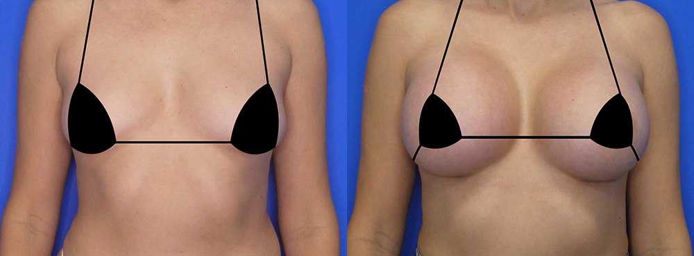 Breast Augmentation Before and After