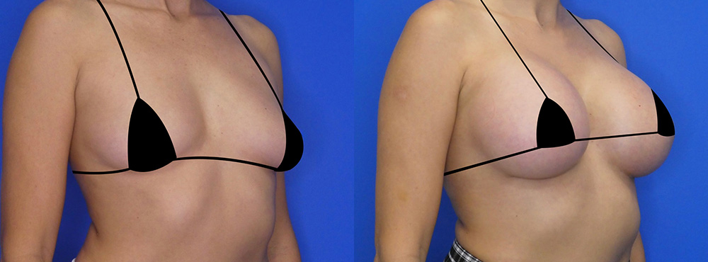 Breast Augmentation Before and After