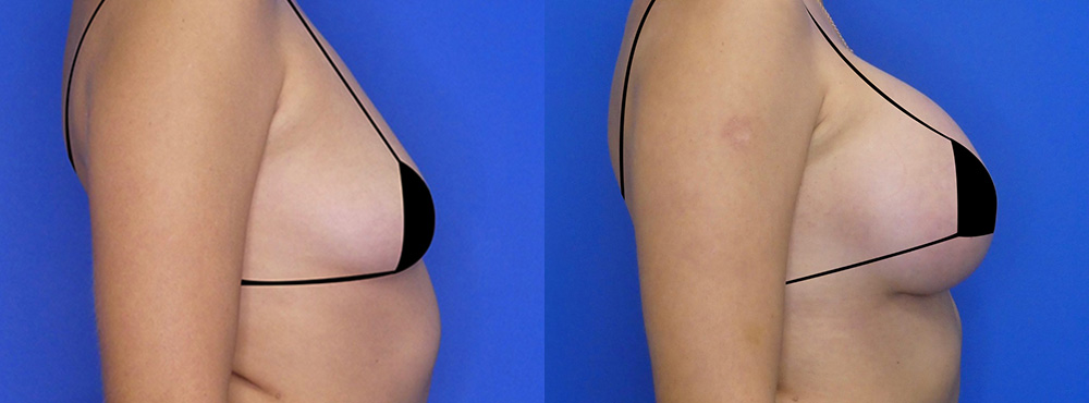 Breast Augmentation Before and After