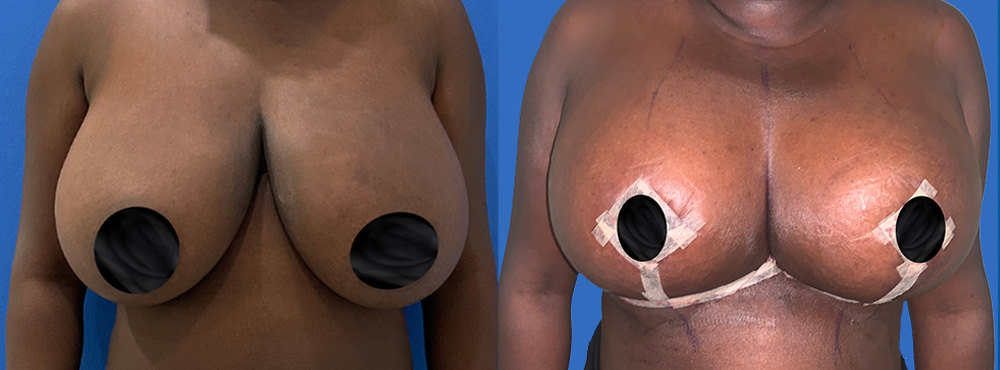 Breast Reduction Before and After in Miami