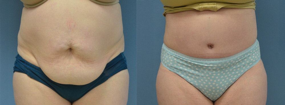 Tummy Before and After