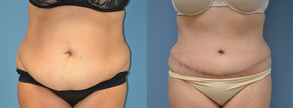 Tummy Tuck Before and After