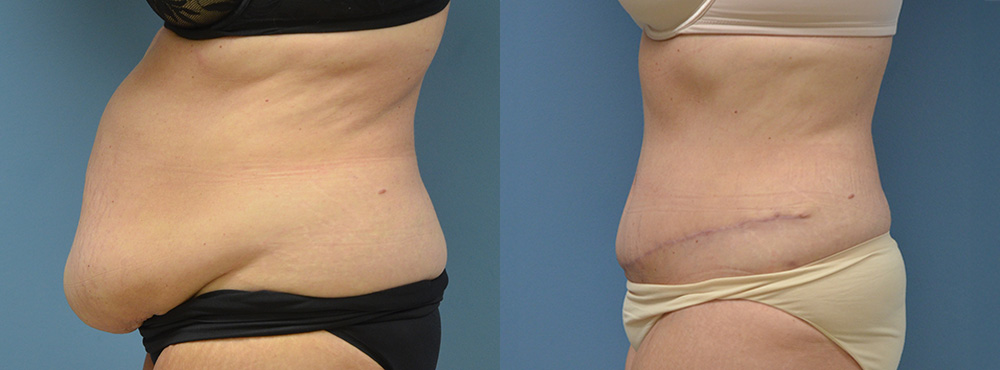 Tummy Tuck Before and After