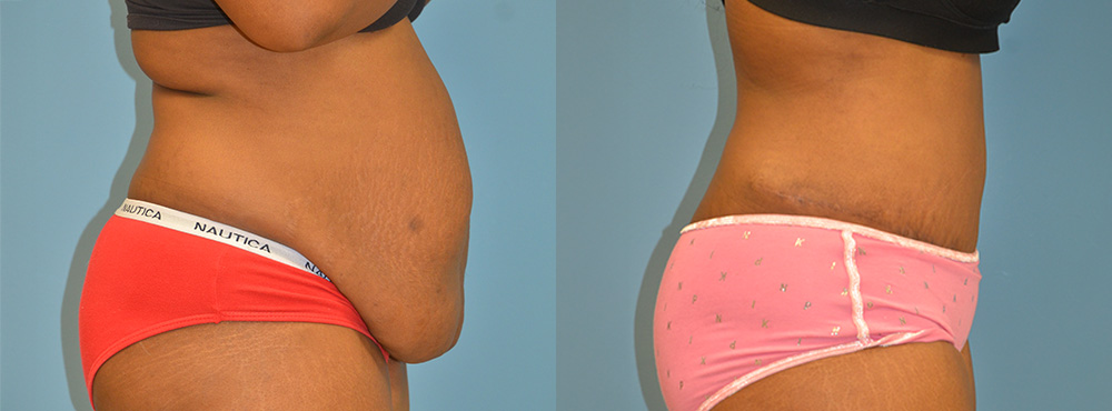 Tummy Tuck Before and After