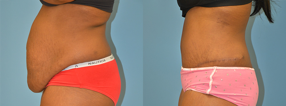 Tummy Tuck Before and After