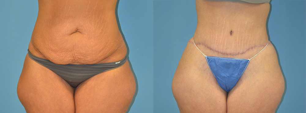 Tummy Tuck Before and After