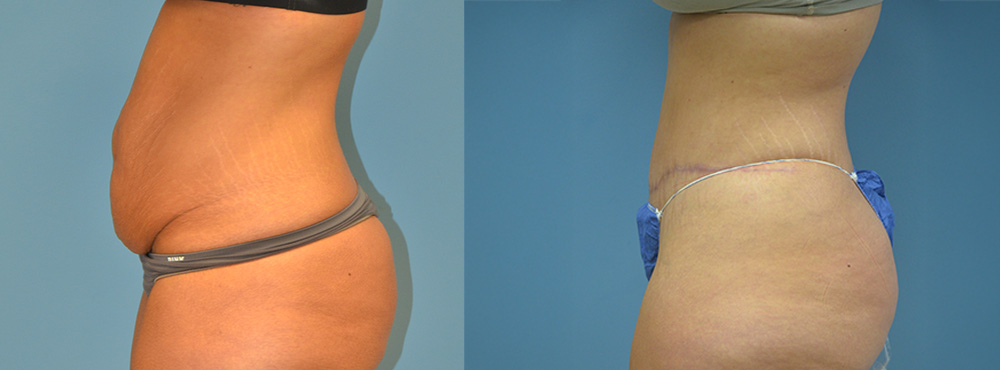 Tummy Tuck Before and After
