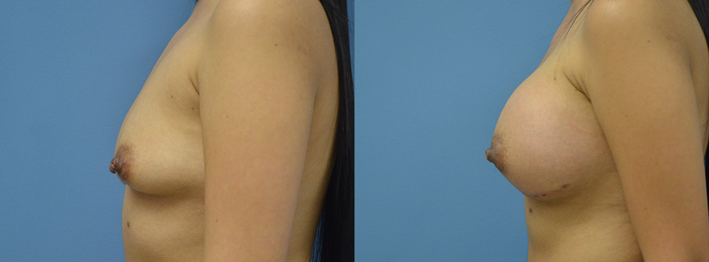 Breast Augmentation Before and After
