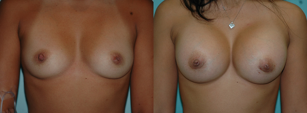 Breast Augmentation Before and After