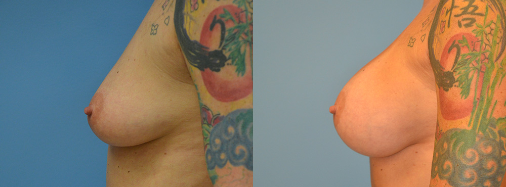 Breast Augmentation Before and After