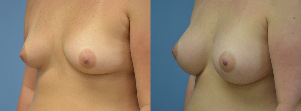 Breast Augmentation Before and After