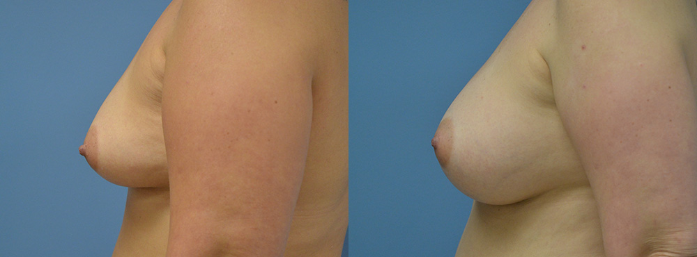 Breast Augmentation Before and After