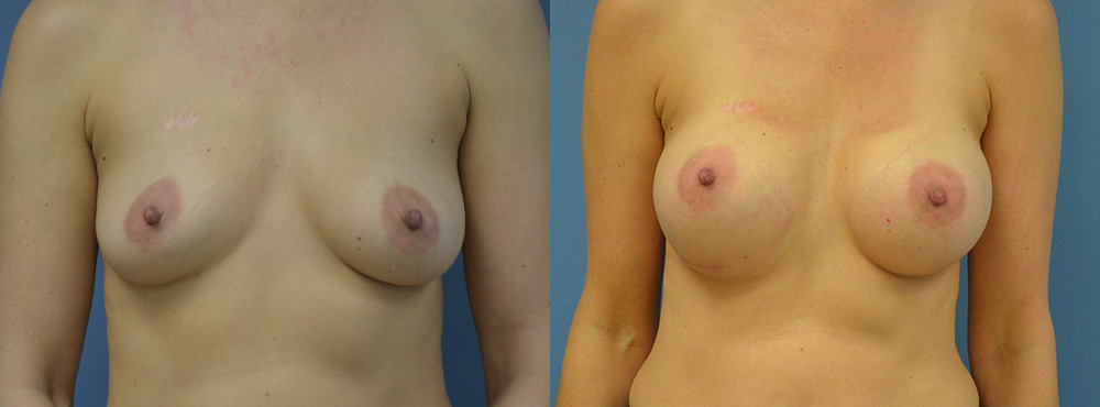 Breast Augmentation Before and After