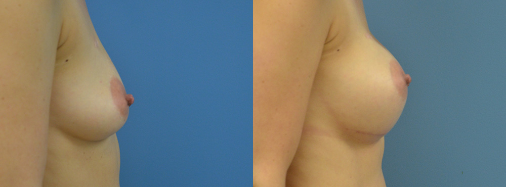 Breast Augmentation Before and After