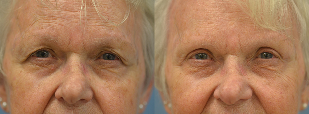 Blepharoplasty Before and After