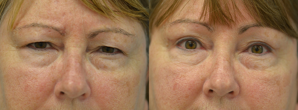Blepharoplasty Before and After