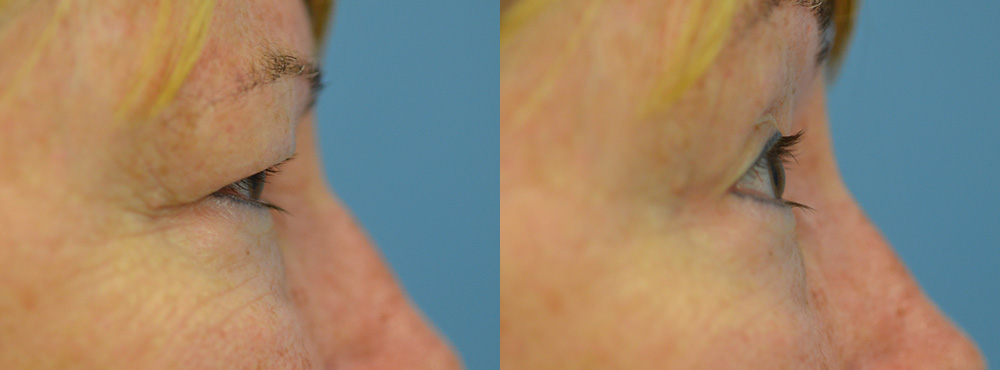 Blepharoplasty Before and After