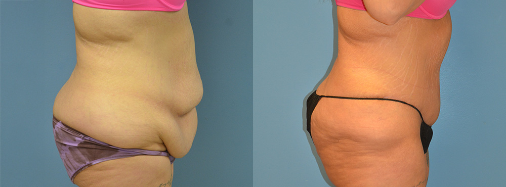 Tummy Tuck Before and After