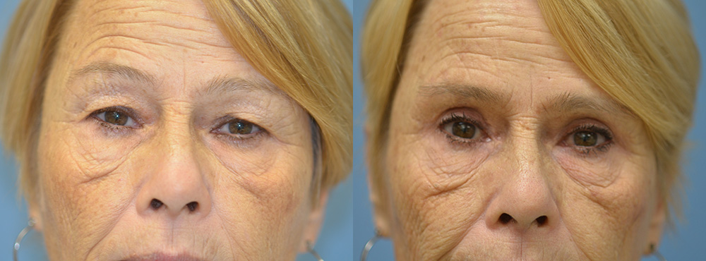 Blepharoplasty Before and After
