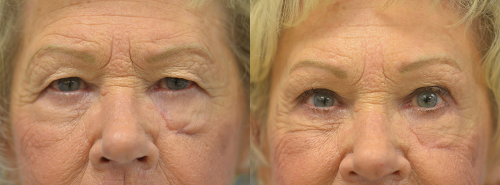 Blepharoplasty Before and After