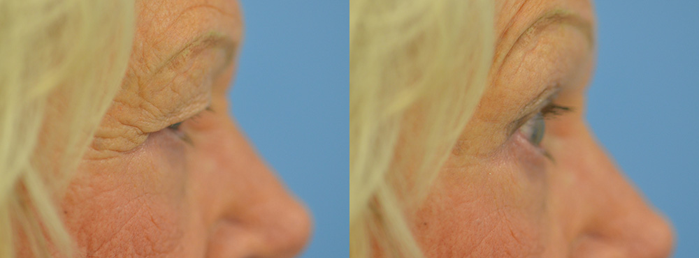 Blepharoplasty Before and After