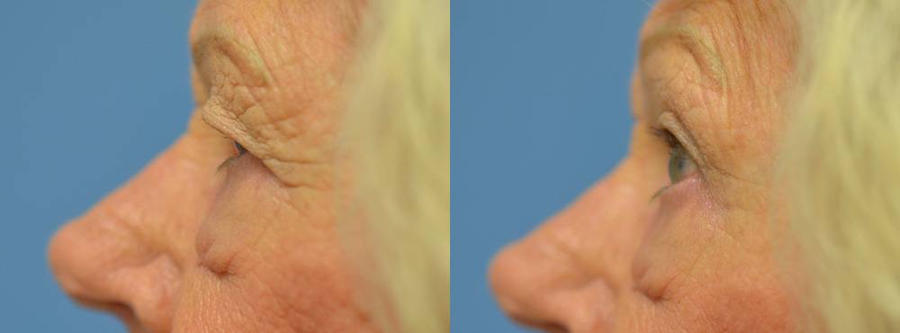 Blepharoplasty Before and After