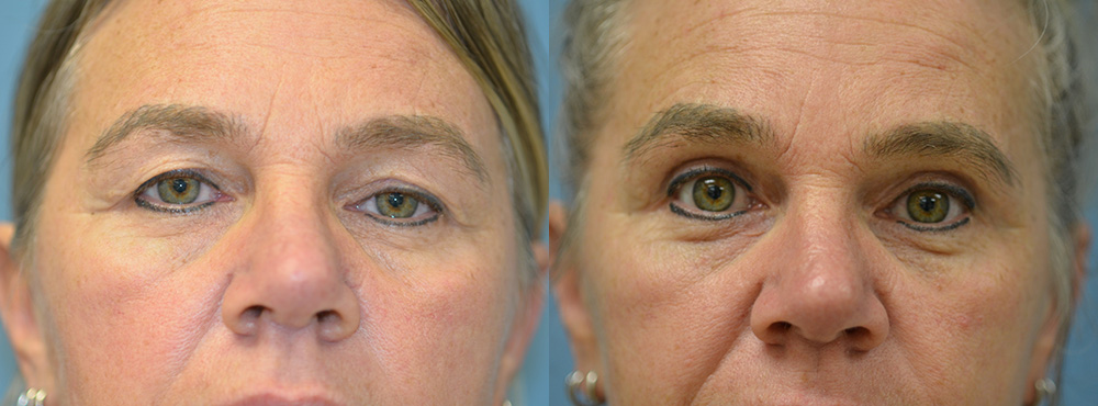 Blepharoplasty Before and After
