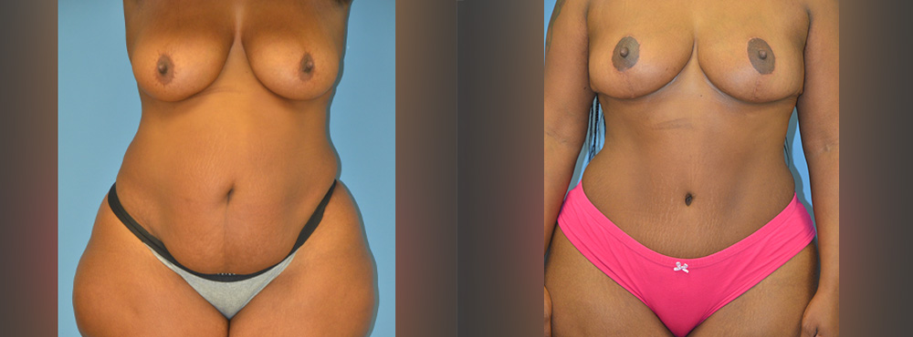 Mommy Makeover Before and After