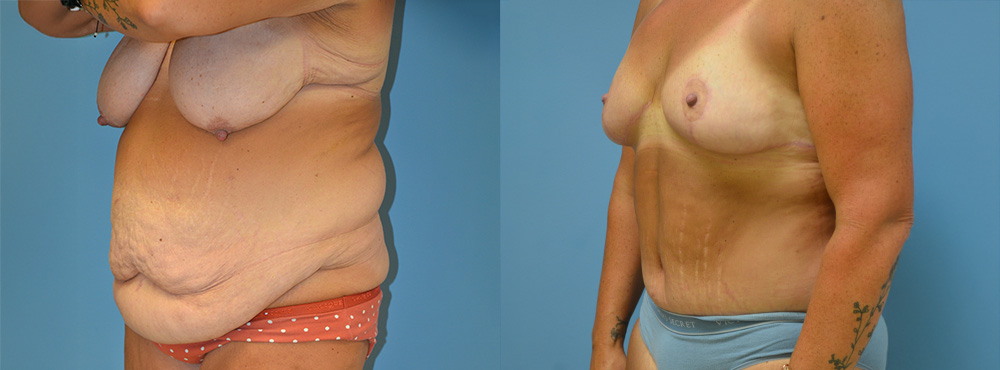 Mommy Makeover Before and After
