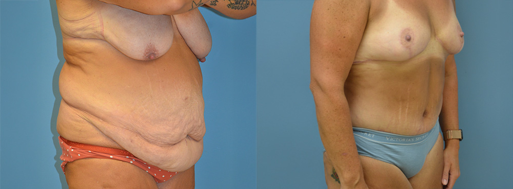 Mommy Makeover Before and After