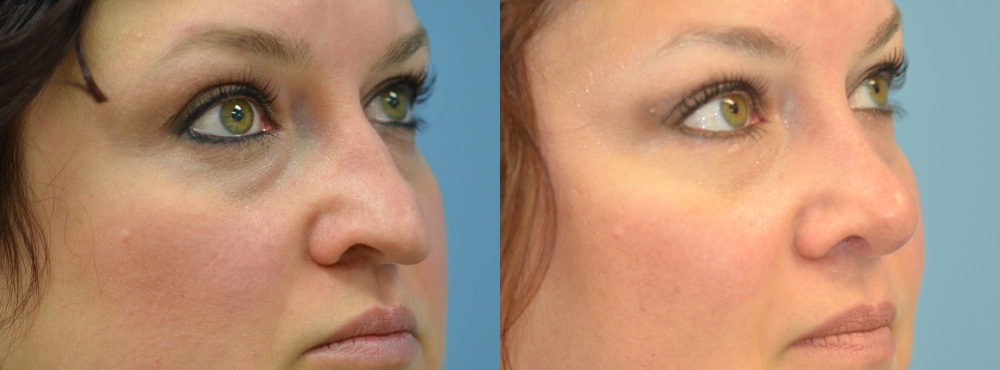 Rhinoplasty Before and After