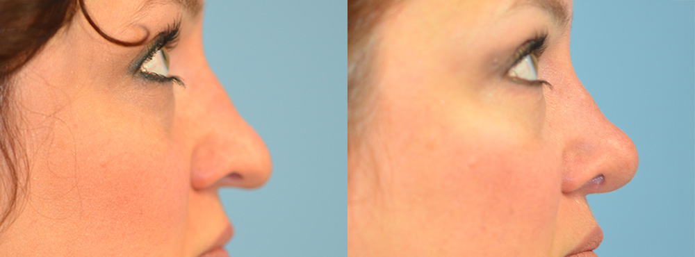 Rhinoplasty Before and After