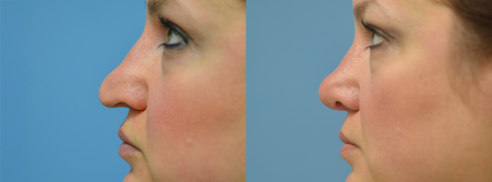 Rhinoplasty Before and After