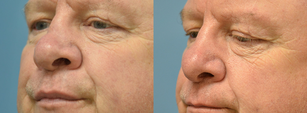 Rhinoplasty Before and After