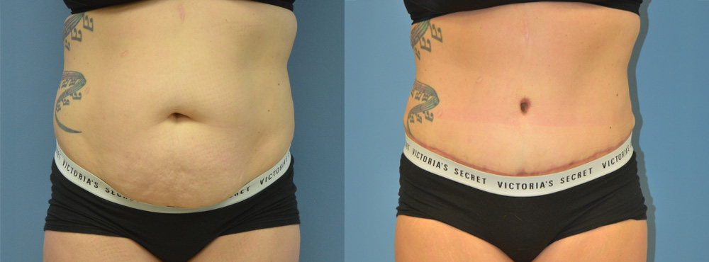 Tummy Tuck Before and After