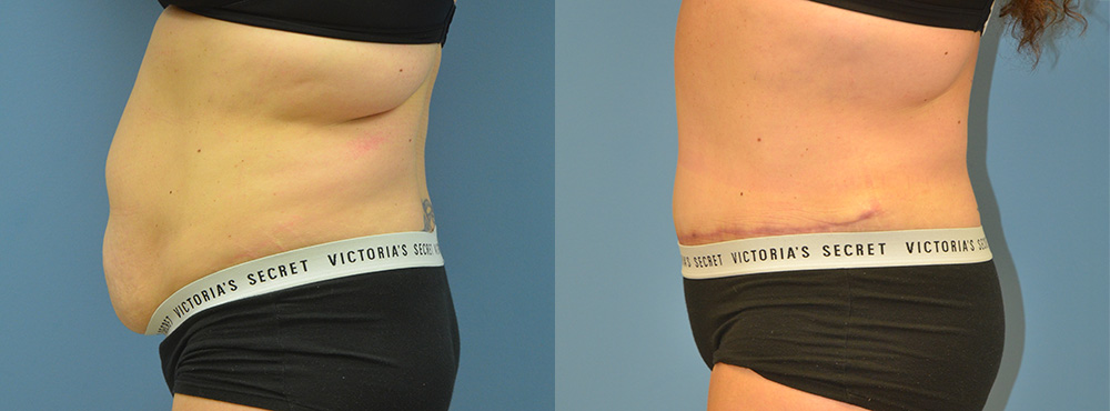 Tummy Tuck Before and After