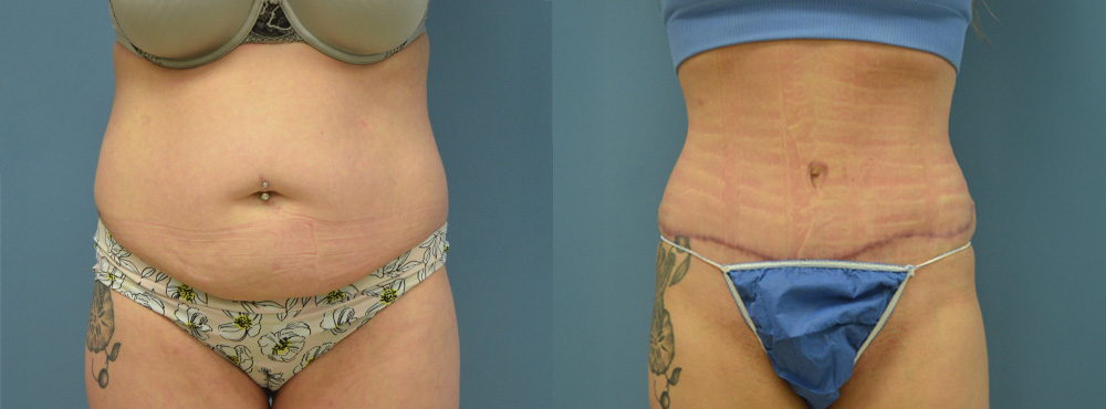 Tummy Tuck Before and After