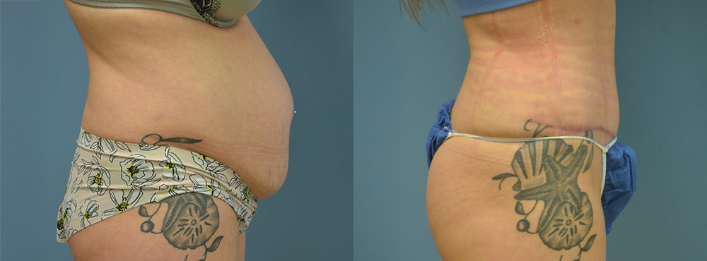 Tummy Tuck Before and After