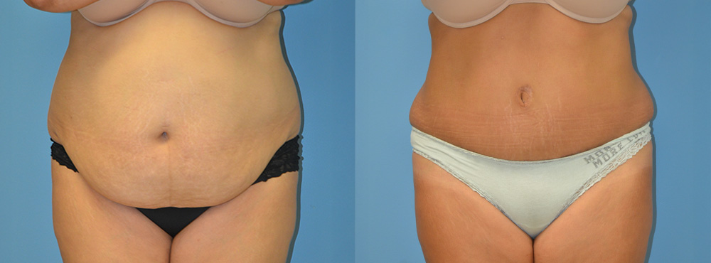 Tummy Tuck Before and After