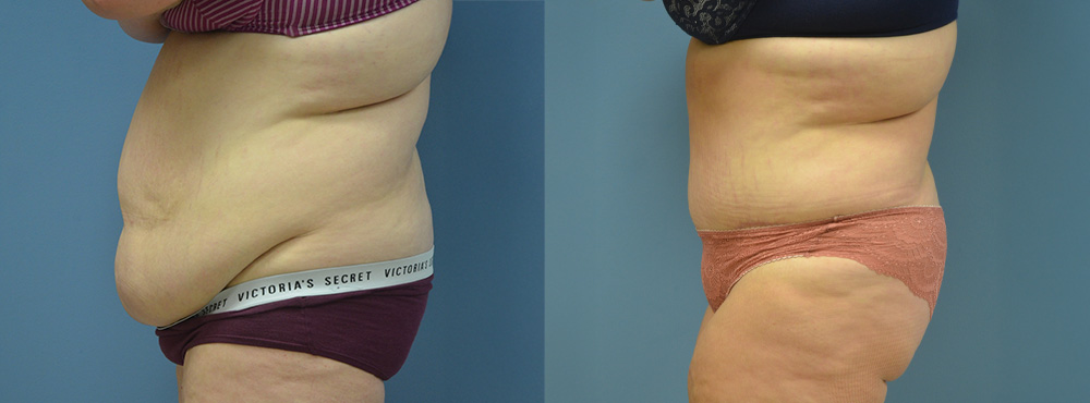 Tummy Before and After