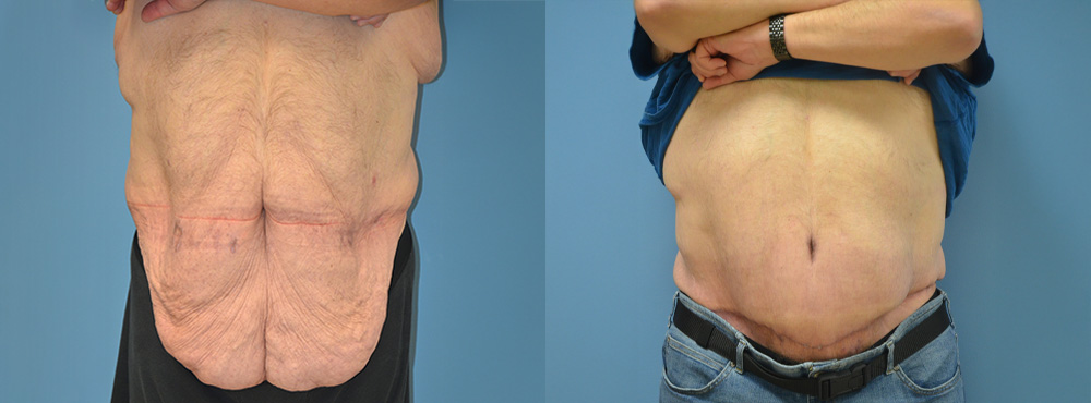 Tummy Tuck Before and After
