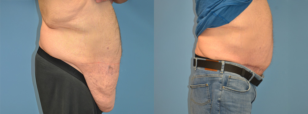 Tummy Tuck Before and After