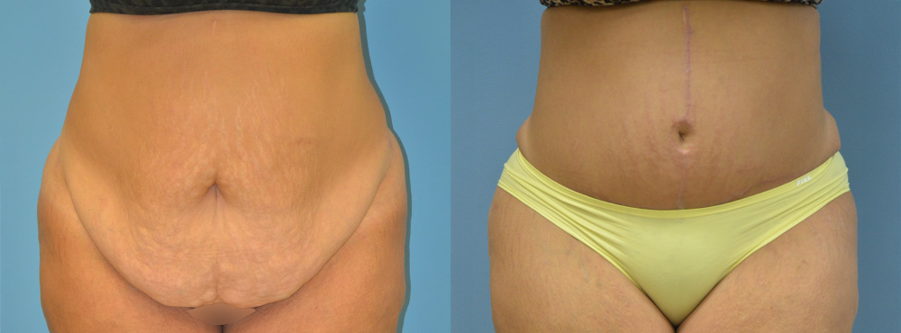 Tummy Before and After