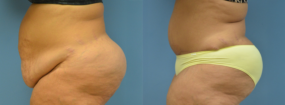 Tummy Before and After