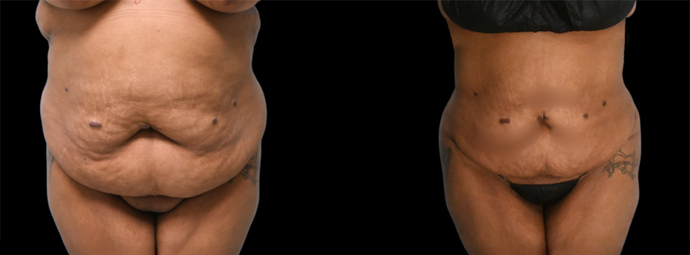 High BMI Lipo Before and After
