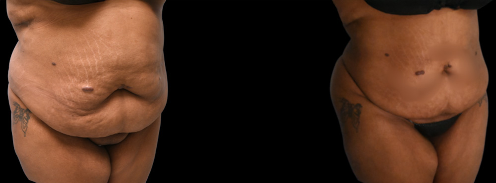 High BMI Lipo Before and After