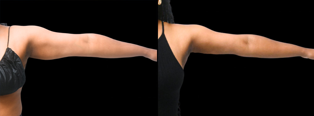 Arm Lift Before and After